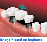 Bridge placed with Implants