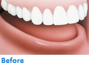 Implant Support Denture