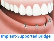 Implant-supported Bridge