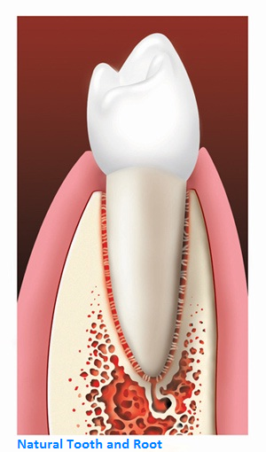 Natural Tooth and Root