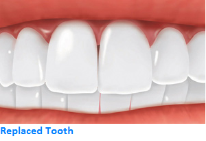 Replaced Tooth