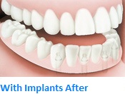 With Implants After