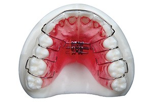 Removable Orthodontic Appliance